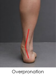 Pronation Overpronation